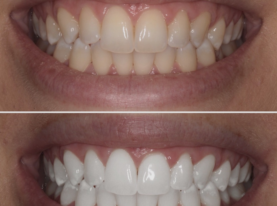 Teeth whitening before and after — real Viva La Vie result